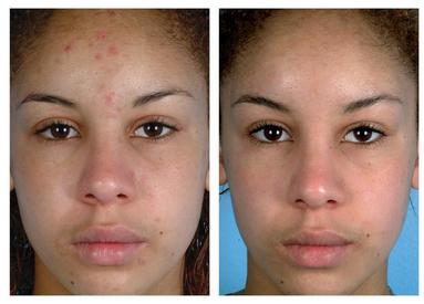 Microdermabrasion (Mechanical Exfoliation) thumbnail 5