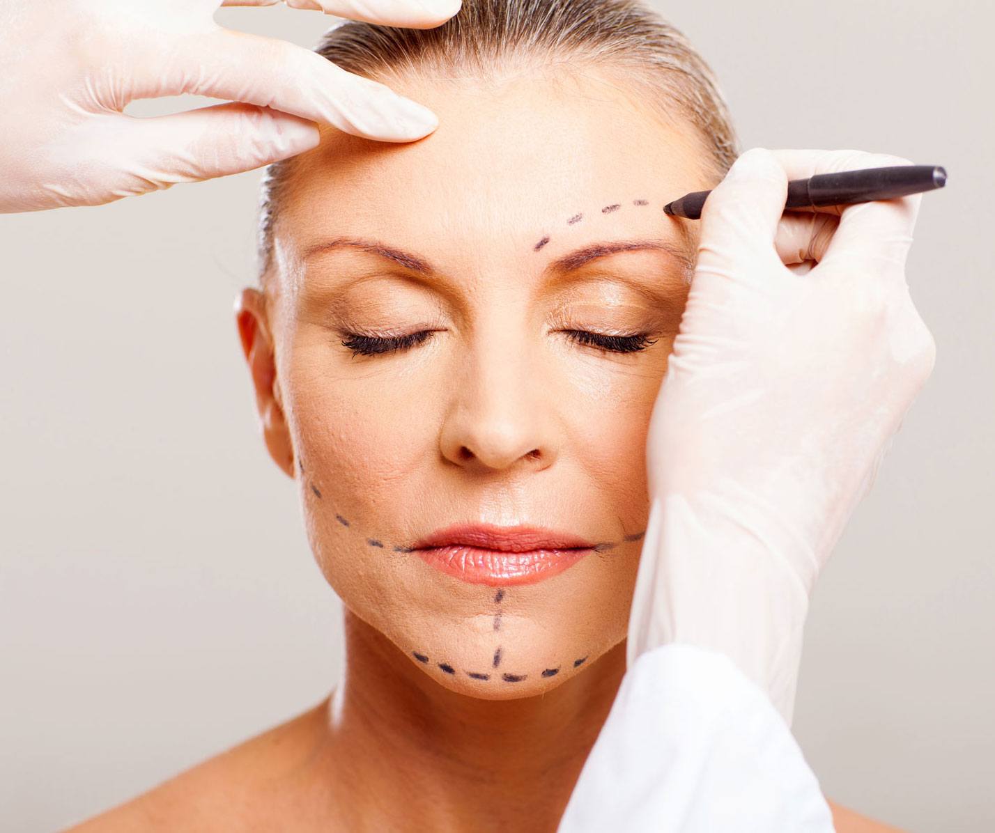 Facelift (Rhytidectomy)