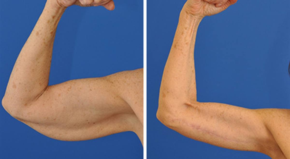 Arm lift surgery before and after results showing improved arm contour