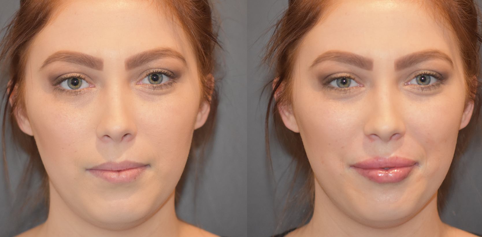 Lip fillers results showing more proportionate lip size