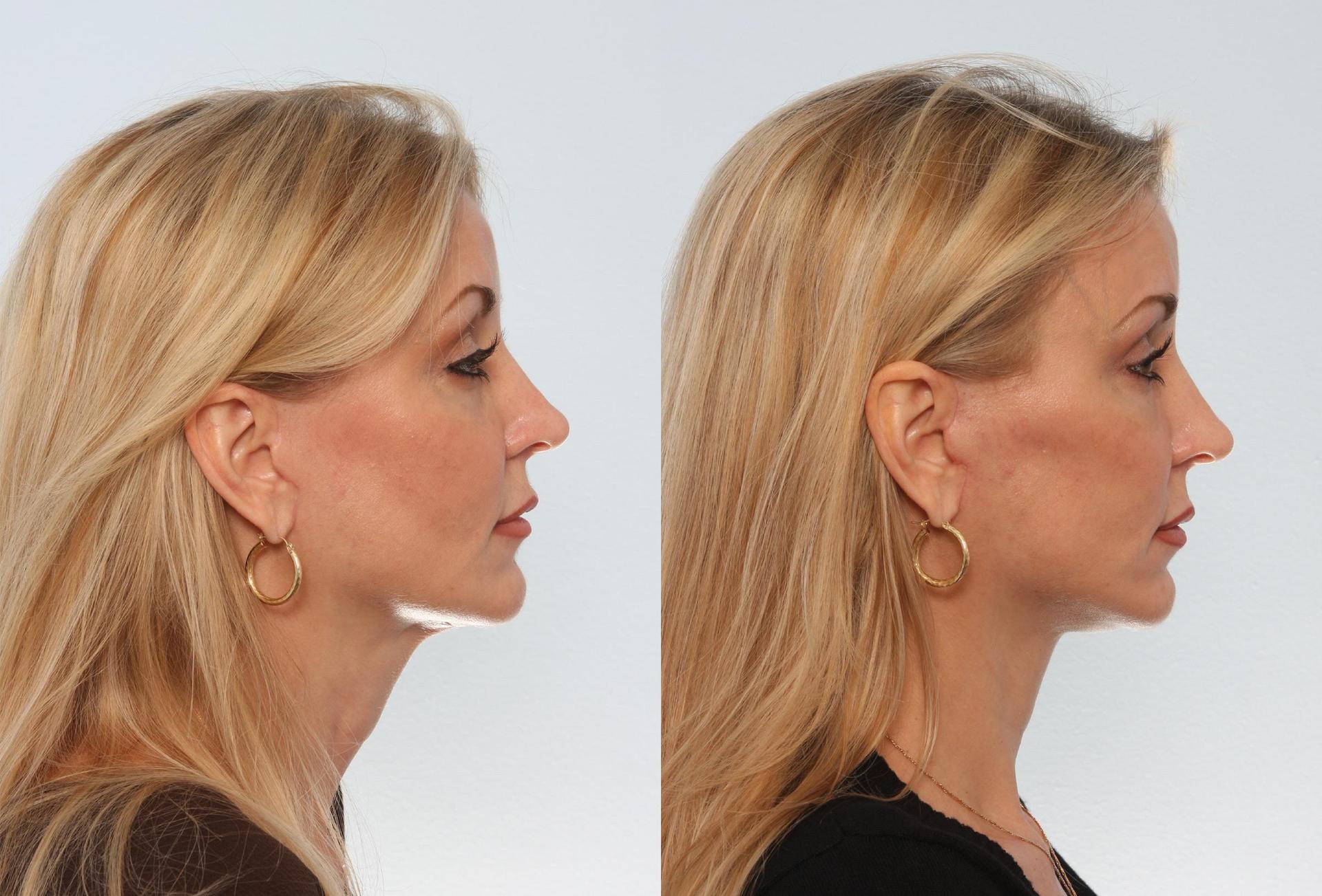Neck lift results showing improved neck contour and jawline definition