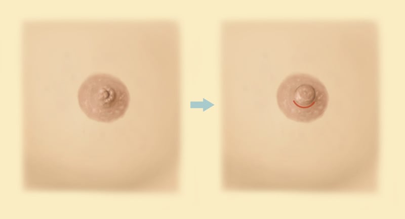 Nipple surgery before and after results