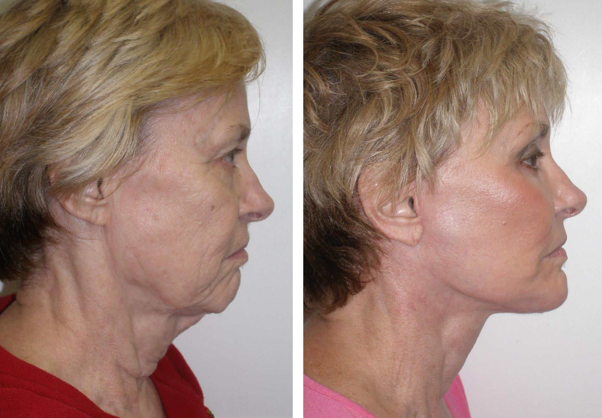 Facelift surgery before and after results