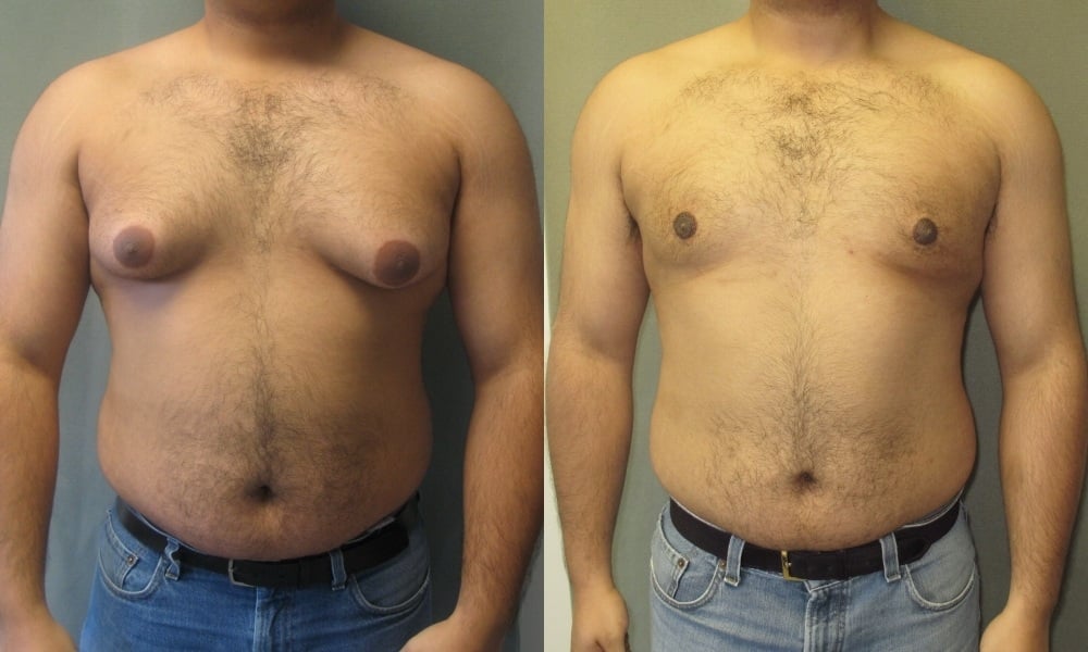 Male breast reduction surgery before and after results