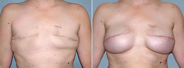 Breast reconstruction surgery before and after results