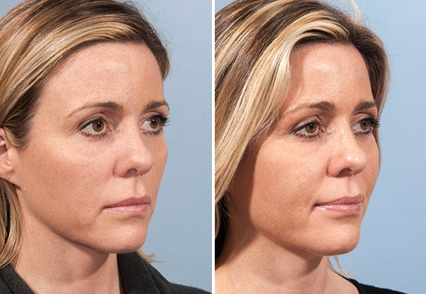 Fat transfer results showing enhanced facial volume and contours