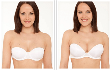 Breast lift surgery before and after results