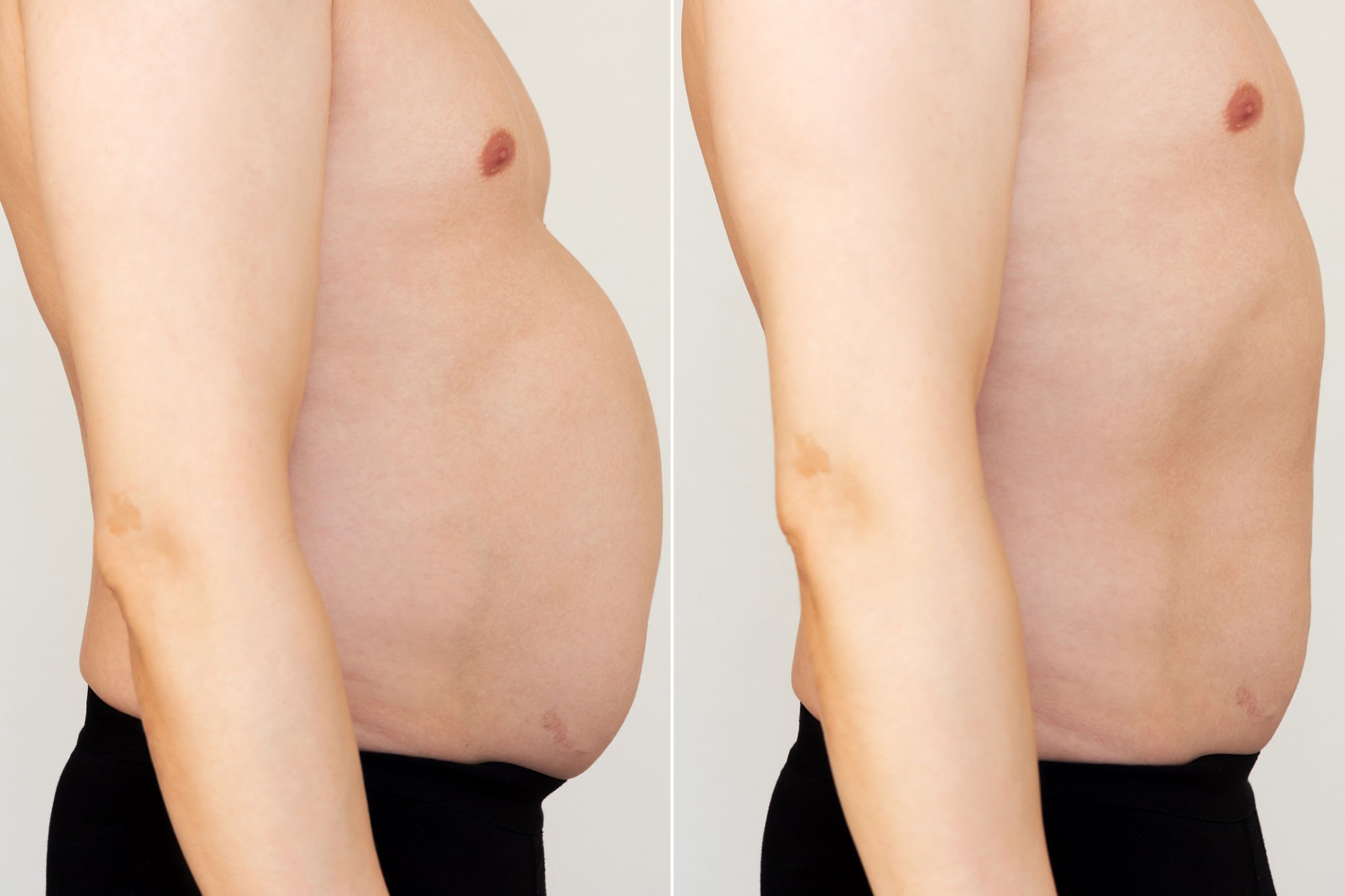 Liposuction before and after results near me Cape Town - Dr Maresky US Board Certified fat removal body contouring for men