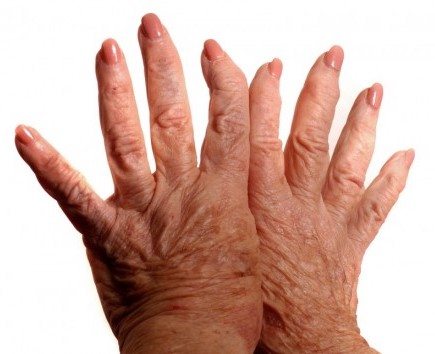 Carpal Tunnel Surgery (Carpal Tunnel Release) - Image 2 of 5