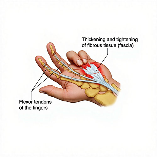 Dupuytren's Contracture (Fasciectomy) - Dr. Gideon Maresky Cape Town