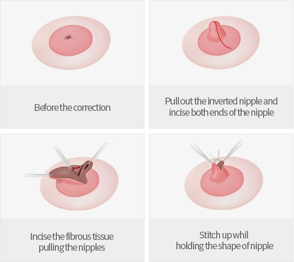 Nipple Surgery (Nipple Correction) - Image 2 of 4