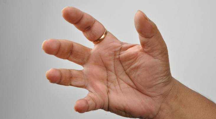 Trigger Finger (Tenolysis) - Image 4 of 5