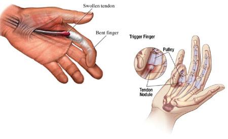 Trigger Finger (Tenolysis) - Image 5 of 5