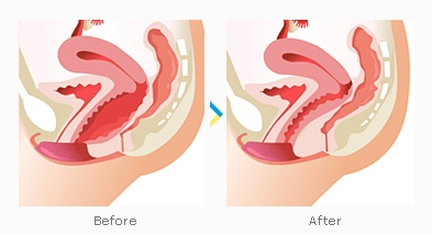 Labiaplasty vaginoplasty intimate surgery before and after results near me Cape Town - Dr Maresky US Board Certified cosmetic surgery
